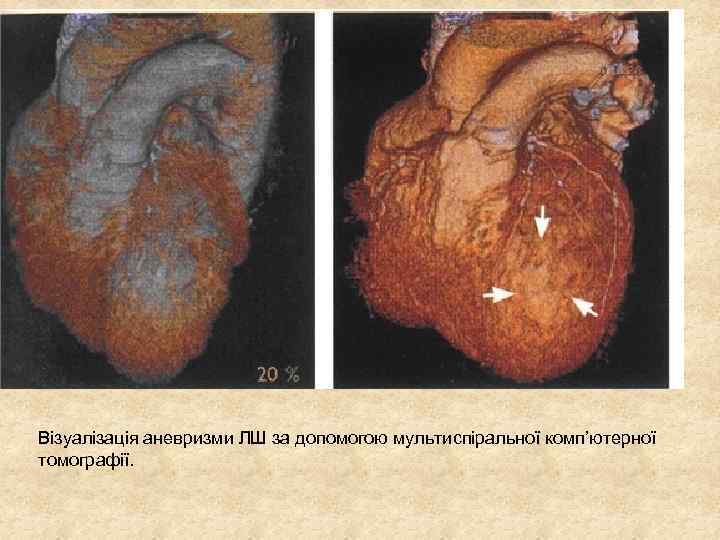 Візуалізація аневризми ЛШ за допомогою мультиспіральної комп’ютерної томографії. 