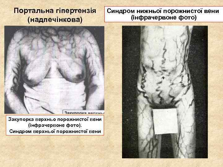 Портальна гіпертензія (надпечінкова) Закупорка верхньо порожнистої вени (інфрачервоне фото). Синдром верхньої порожнистої вени Синдром