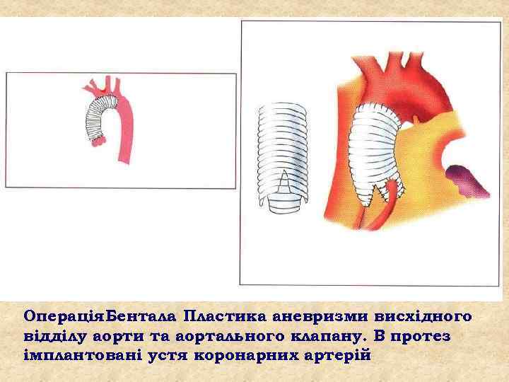 Операція. Бентала Пластика аневризми висхідного. відділу аорти та аортального клапану. В протез імплантовані устя