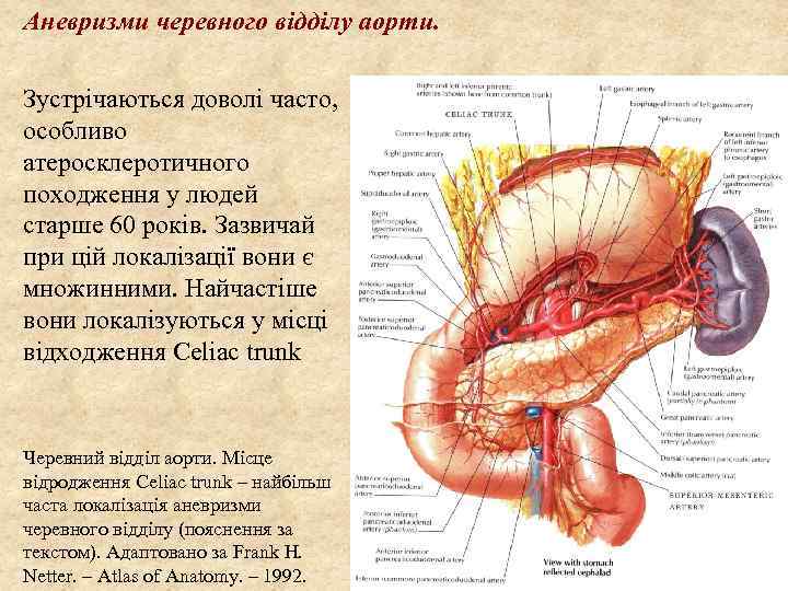 Аневризми черевного відділу аорти. Зустрічаються доволі часто, особливо атеросклеротичного походження у людей старше 60