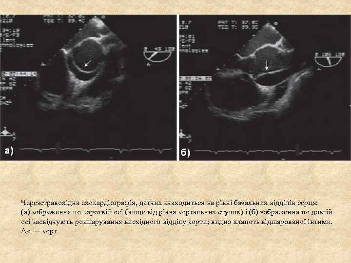 Черезстравохідна ехокардіографія, датчик знаходиться на рівні базальних відділів серця: (а) зображення по короткій осі