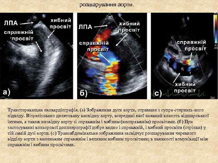 розшарування аорти. Трансторакальна ехокардіографія. (а) Зображення дуги аорти, отримане з супра стерналь ного підходу.