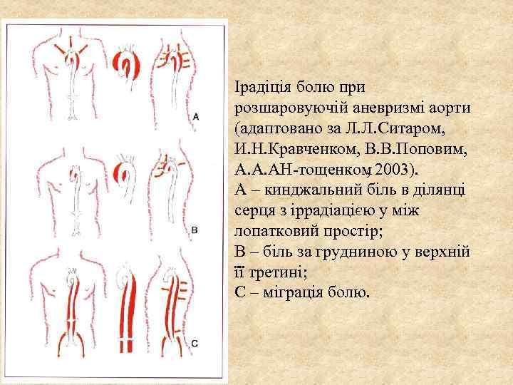 Ірадіція болю при розшаровуючій аневризмі аорти (адаптовано за Л. Л. Ситаром, И. Н. Кравченком,