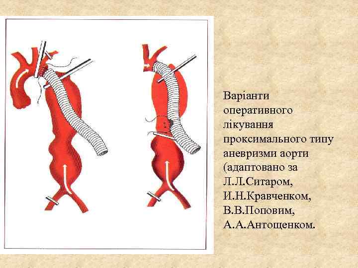 Варіанти оперативного лікування проксимального типу аневризми аорти (адаптовано за Л. Л. Ситаром, И. Н.