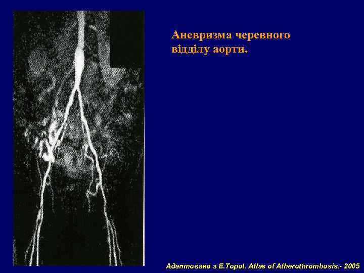 Аневризма черевного відділу аорти. Адаптовано з E. Topol. Atlas of Atherothrombosis. - 2005 