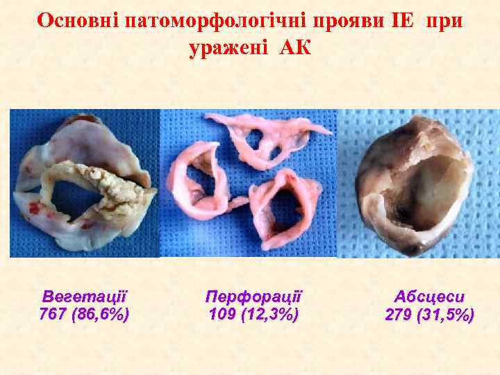 Основні патоморфологічні прояви ІЕ при уражені АК Вегетації 767 (86, 6%) Перфорації 109 (12,