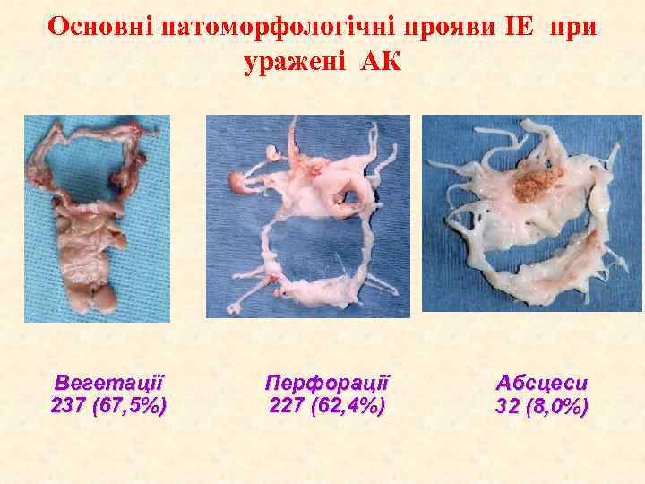 Основні патоморфологічні прояви ІЕ при уражені АК Вегетації 237 (67, 5%) Перфорації 227 (62,