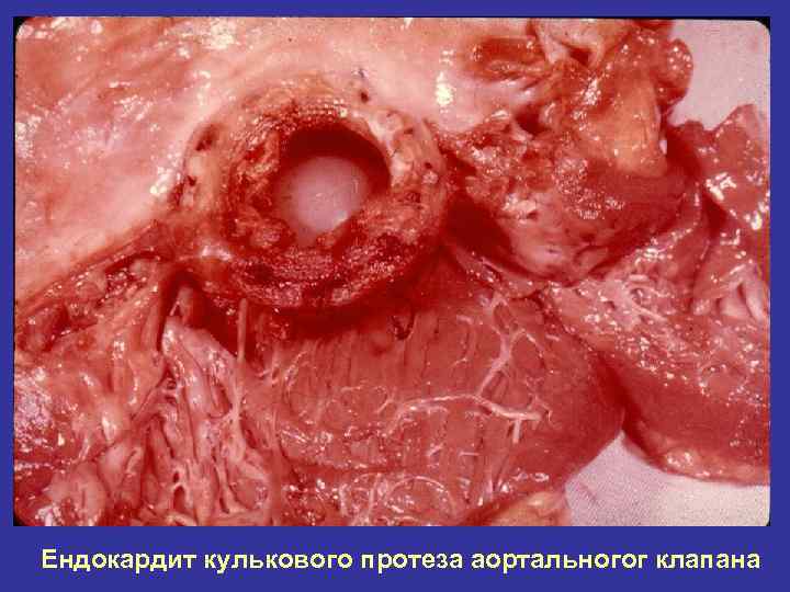 Ендокардит кулькового протеза аортальногог клапана 