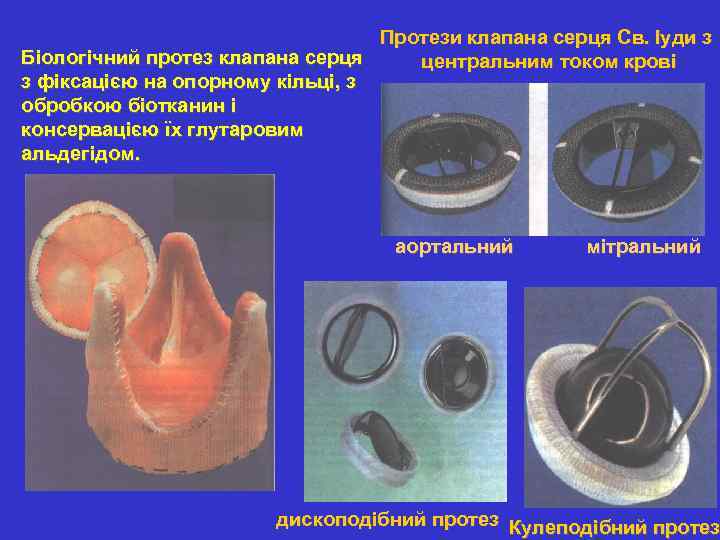 Протези клапана серця Св. Іуди з Біологічний протез клапана серця центральним током крові з