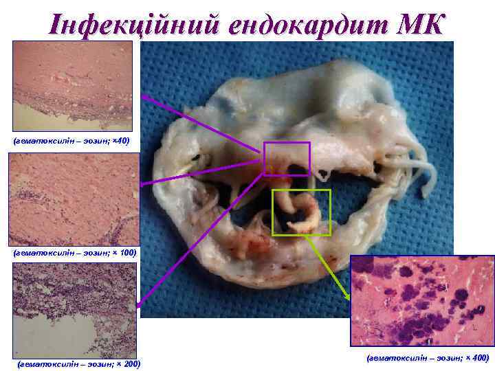 Інфекційний ендокардит МК (гематоксилін – эозин; × 40) (гематоксилін – эозин; × 100) (гематоксилін