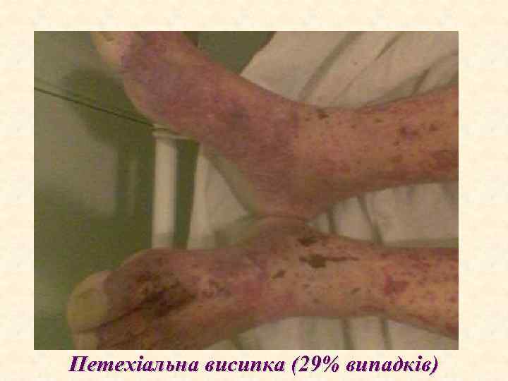 Петехіальна висипка (29% випадків) 