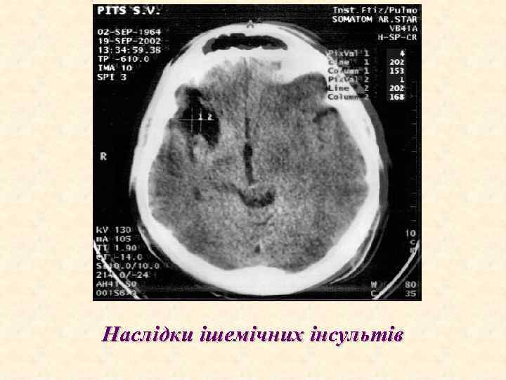 Наслідки ішемічних інсультів 