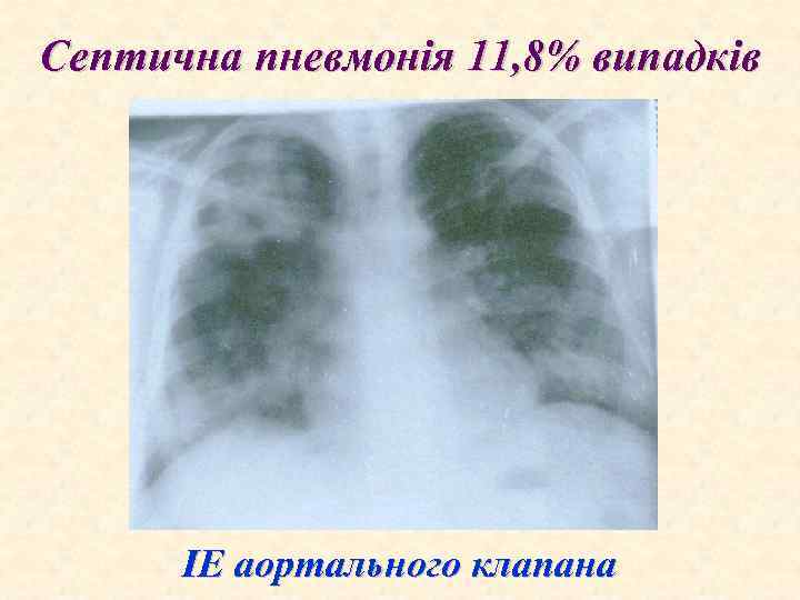 Септична пневмонія 11, 8% випадків ІЕ аортального клапана 