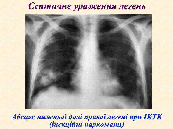 Септичне ураження легень Абсцес нижньої долі правої легені при ІКТК (інєкційні наркомани) 