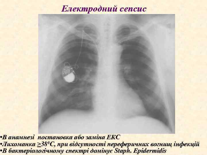 Електродний сепсис • В анамнезі постановка або заміна ЕКС • Лихоманка >380 С, при