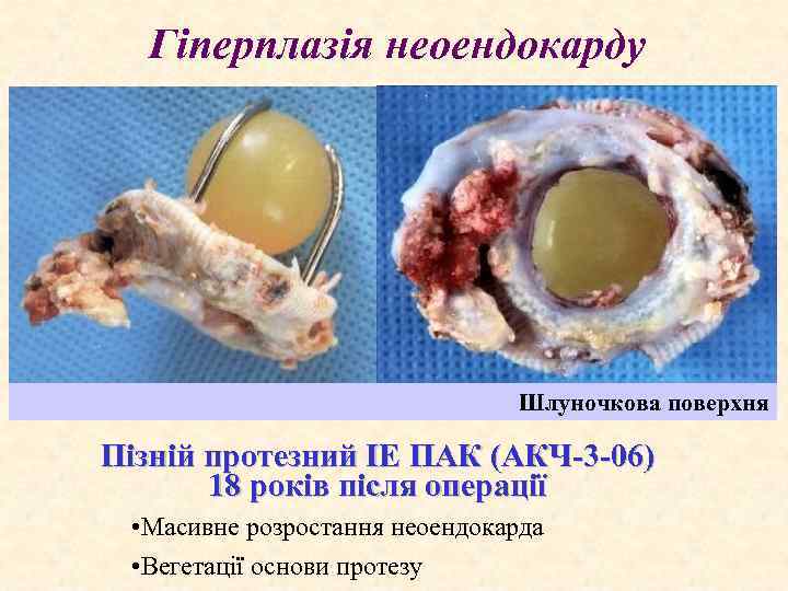Гіперплазія неоендокарду Шлуночкова поверхня Пізній протезний ІЕ ПАК (АКЧ-3 -06) 18 років після операції