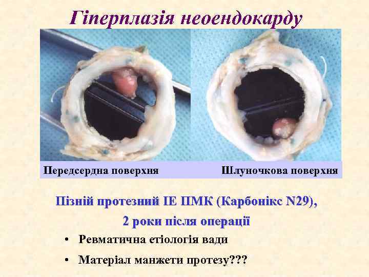Гіперплазія неоендокарду Передсердна поверхня Шлуночкова поверхня Пізній протезний ІЕ ПМК (Карбонікс N 29), 2