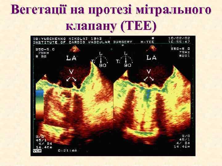 Вегетації на протезі мітрального клапану (ТЕЕ) 