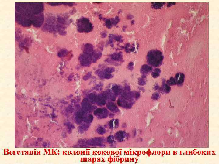 Вегетація МК: колонії кокової мікрофлори в глибоких шарах фібрину 