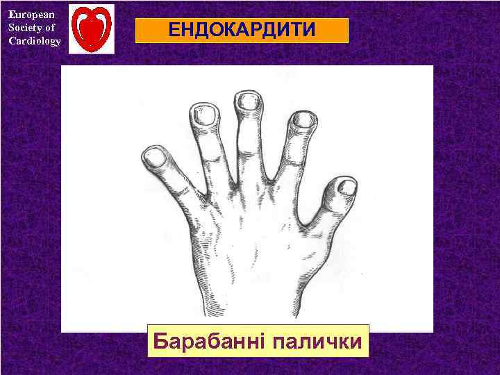 European Society of Cardiology ЕНДОКАРДИТИ Барабанні палички 