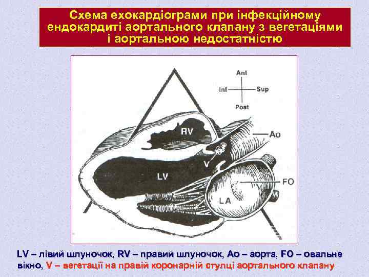 Схема ехокардіограми при інфекційному ендокардиті аортального клапану з вегетаціями і аортальною недостатністю LV –