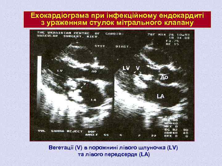 Ехокардіограма при інфекційному ендокардиті з ураженням стулок мітрального клапану LV V Ao LA Вегетації