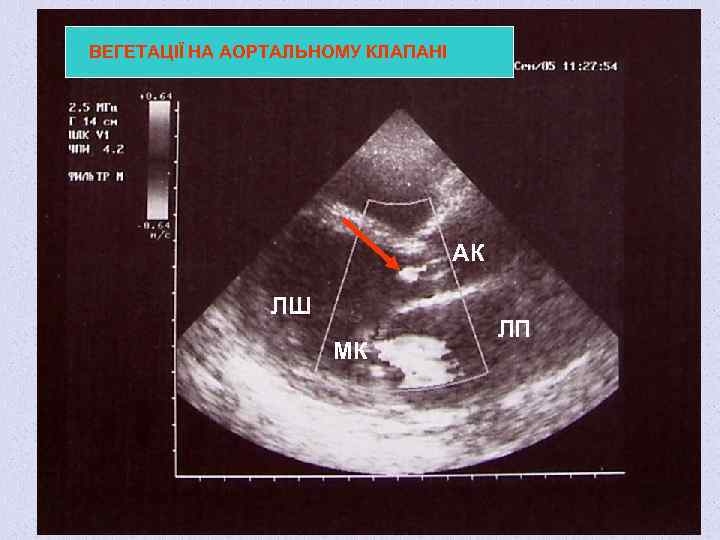 ВЕГЕТАЦІЇ НА АОРТАЛЬНОМУ КЛАПАНІ АК ЛШ МК ЛП 