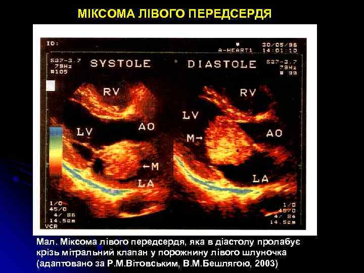 МІКСОМА ЛІВОГО ПЕРЕДСЕРДЯ Мал. Міксома лівого передсердя, яка в діастолу пролабує крізь мітральний клапан