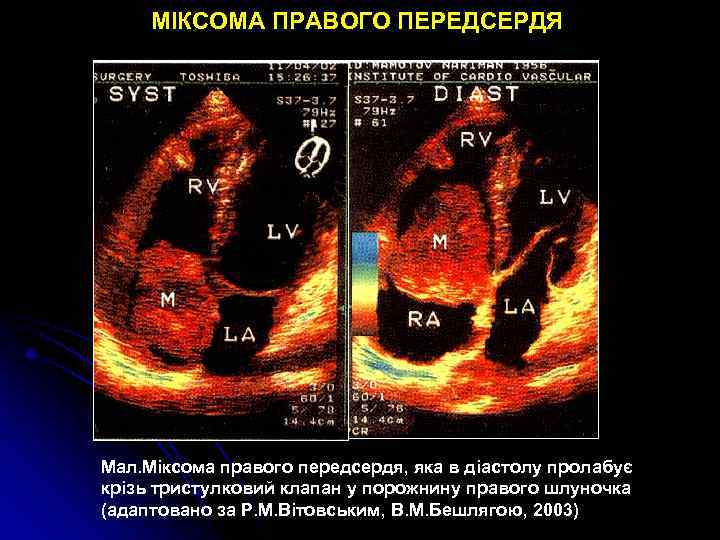 МІКСОМА ПРАВОГО ПЕРЕДСЕРДЯ Мал. Міксома правого передсердя, яка в діастолу пролабує крізь тристулковий клапан