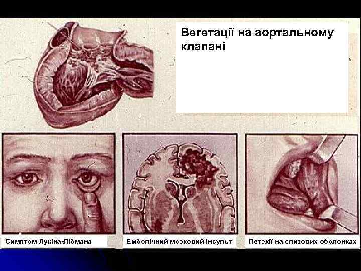 Вегетації на аортальному клапані Симптом Лукіна-Лібмана Емболічний мозковий інсульт Петехії на слизових оболонках 