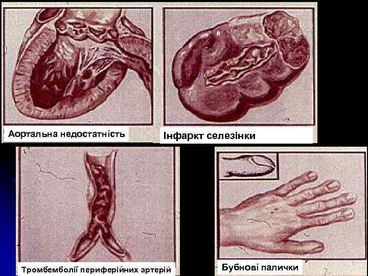 Аортальна недостатність Інфаркт селезінки Тромбемболії периферійних артерій Бубнові палички 
