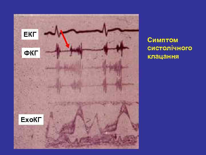 ЕКГ ФКГ Ехо. КГ Симптом систолічного клацання 
