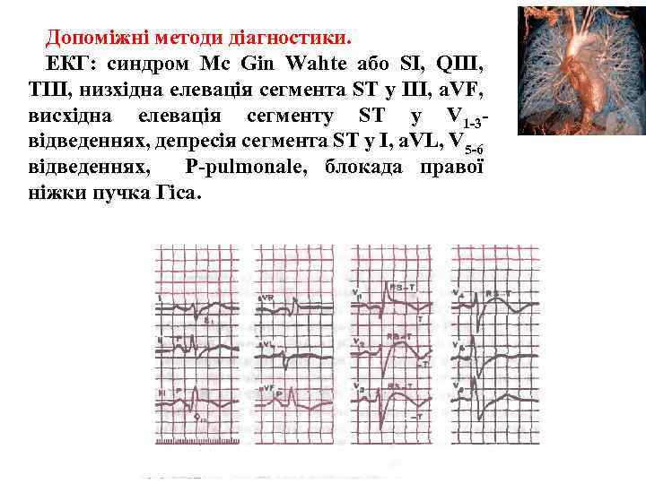 Допоміжні методи діагностики. ЕКГ: синдром Mc Gin Wahte або SІ, QIII, TIII, низхідна елевація