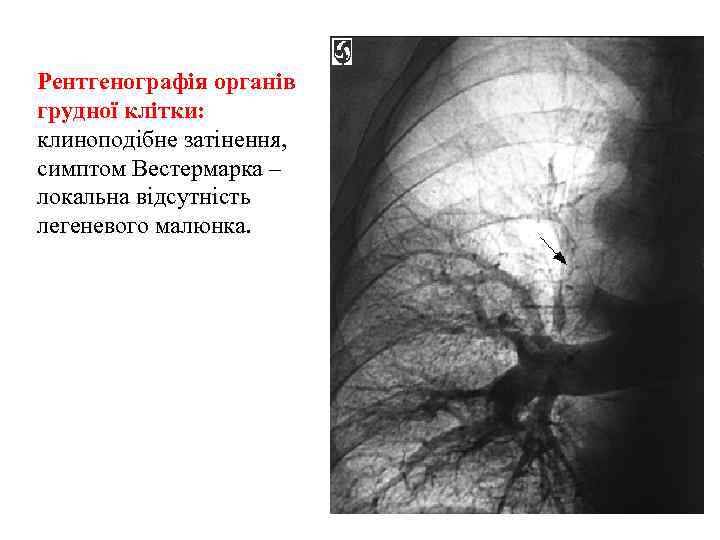 Рентгенографія органів грудної клітки: клиноподібне затінення, симптом Вестермарка – локальна відсутність легеневого малюнка. 