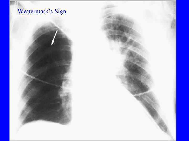 Westermark’s Sign PE 