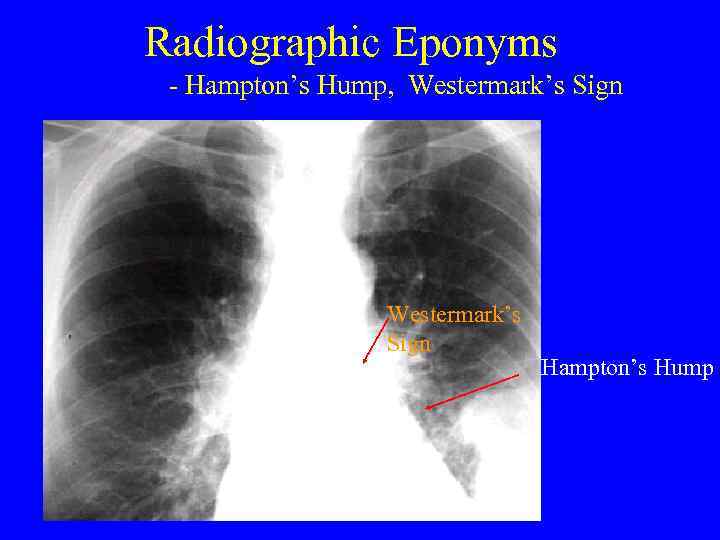 Radiographic Eponyms - Hampton’s Hump, Westermark’s Sign Hampton’s Hump 