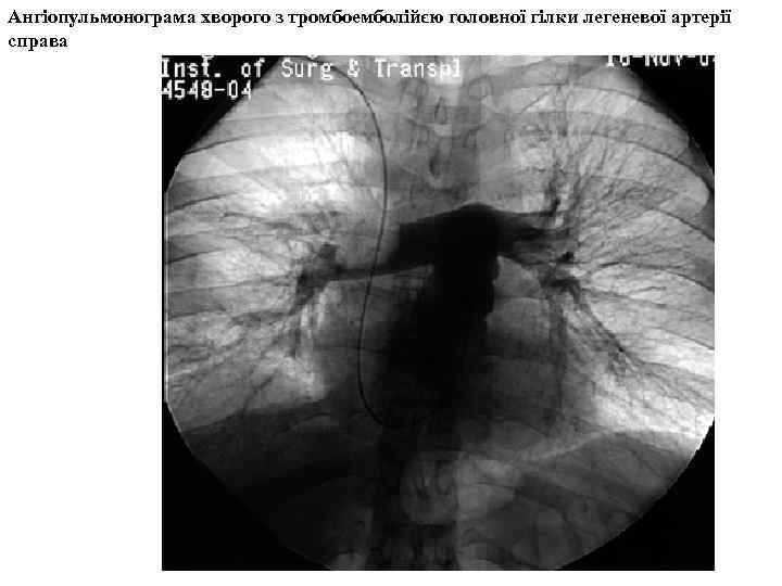 Ангіопульмонограма хворого з тромбоемболійєю головної гілки легеневої артерії справа 