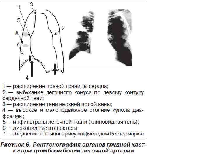 Дилатация правых отделов. Тромбоэмболия лёгочной артерии симптомы рентген. Тромбоэмболия легочной артерии УЗИ. Эмболия легочной артерии рентген. Тромбоэмболия легочной артерии рентген.