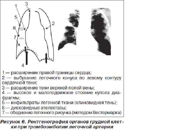 Расширение левой. Симптомом тромбоэмболии легочной артерии на рентгене. Рентгенография легких при Тэла. Тромбоэмболия легочной артерии рентген. Рентгенограмма легких при Тэла.