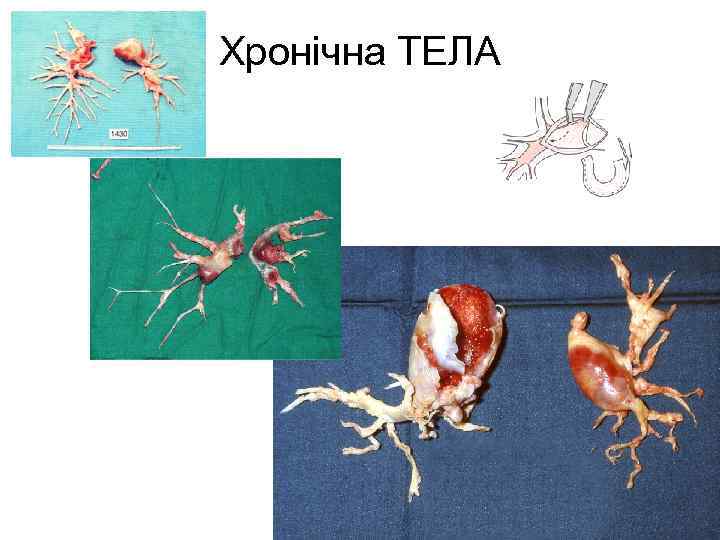 Хронічна ТЕЛА 