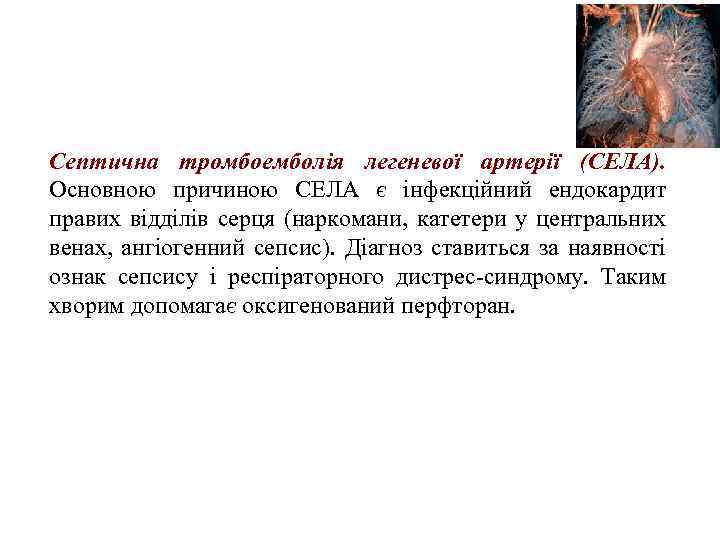 Септична тромбоемболія легеневої артерії (СЕЛА). Основною причиною СЕЛА є інфекційний ендокардит правих відділів серця