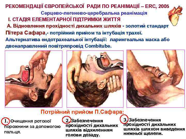 РЕКОМЕНДАЦІЇ ЄВРОПЕЙСЬКОЇ РАДИ ПО РЕАНІМАЦІЇ – ERC, 2005 Серцево-легенево-церебральна реанімація І. СТАДІЯ ЕЛЕМЕНТАРНОЇ ПІДТРИМКИ