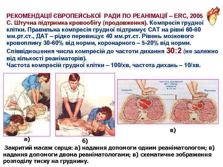 РЕКОМЕНДАЦІЇ ЄВРОПЕЙСЬКОЇ РАДИ ПО РЕАНІМАЦІЇ – ERC, 2005 С. Штучна підтримка кровообігу (продовження). Компресія