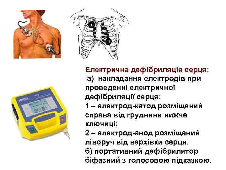1 2 2 а) б) Електрична дефібриляція серця: а) накладання електродів при проведенні електричної