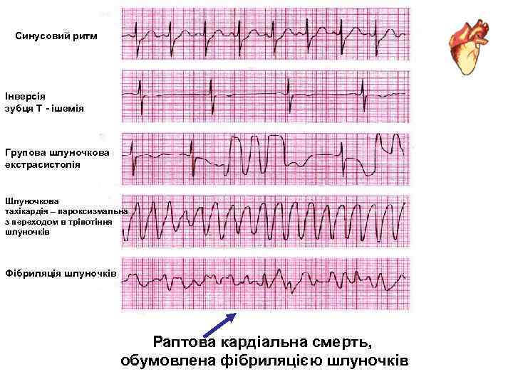 Синусовий ритм Інверсія зубця Т - ішемія Групова шлуночкова екстрасистолія Шлуночкова тахікардія – пароксизмальна