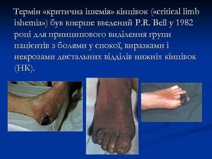 Термін «критична ішемія» кінцівок ( «critical limb ishemia» ) був вперше введений P. R.