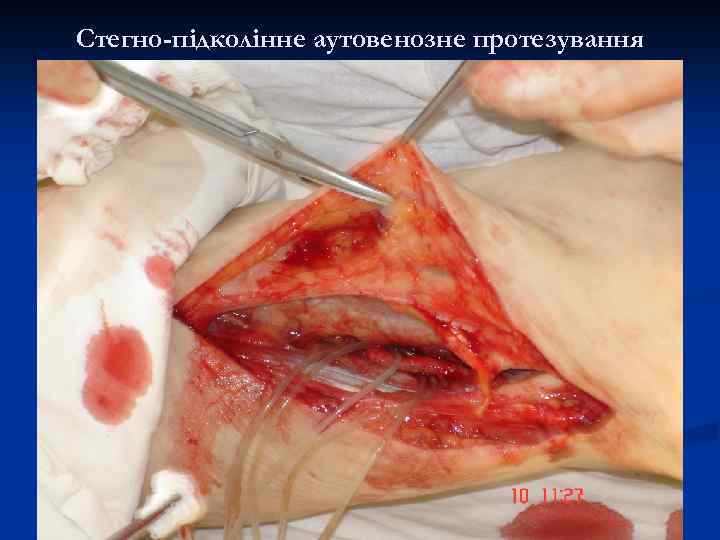 Стегно-підколінне аутовенозне протезування 