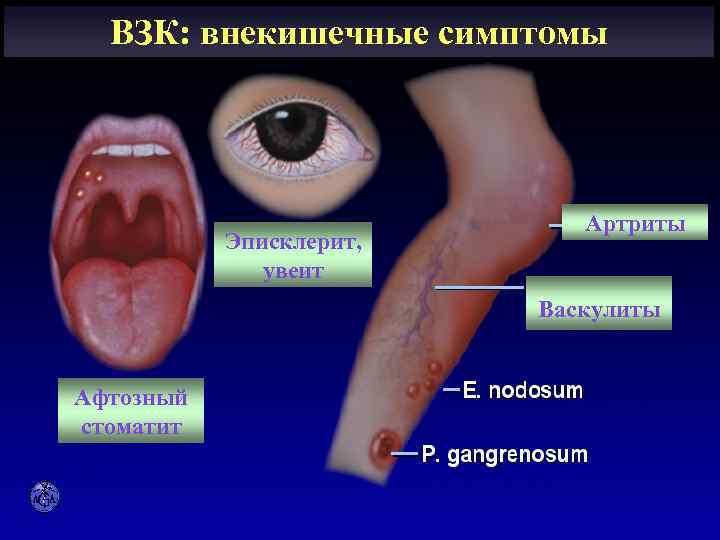 ВЗК: внекишечные симптомы EXTRAINTESTINAL MANIFESTATIONS Эписклерит, увеит Артриты Васкулиты Афтозный стоматит 