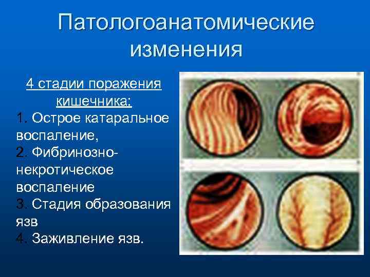 Патологоанатомические изменения 4 стадии поражения кишечника: 1. Острое катаральное воспаление, 2. Фибринознонекротическое воспаление 3.