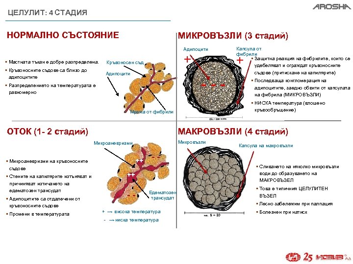 ЦЕЛУЛИТ: 4 СТАДИЯ НОРМАЛНО СЪСТОЯНИЕ МИКРОВЪЗЛИ (3 стадий) Адипоцити § Мастната тъкан е добре